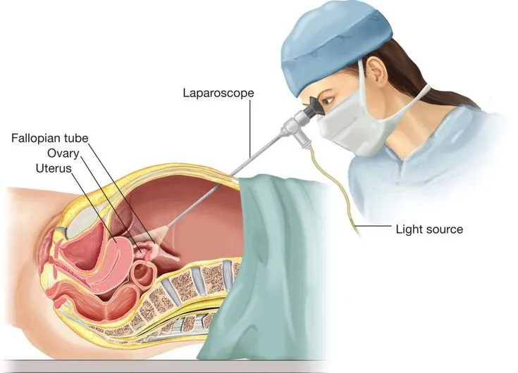 Laparoscopic Fibroid Removal Specialist in Andheri West,Mumbai image 1